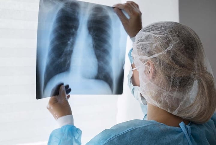 País busca reducir la incidencia de tuberculosis