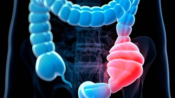 Megacolon congénito, una enfermedad poco conocida que afecta a decenas de niños en el país